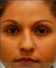Revision/Corrective Rhinoplasty