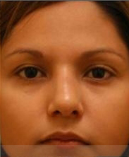Revision/Corrective Rhinoplasty