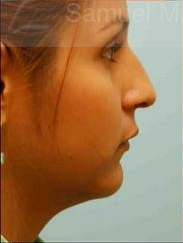 Revision/Corrective Rhinoplasty