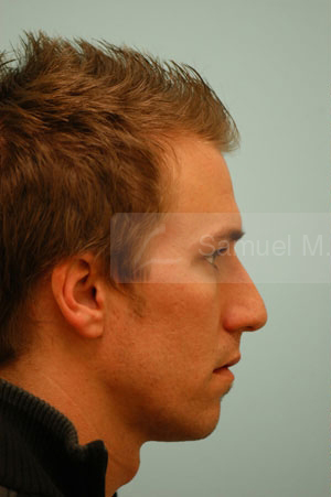 Revision/Corrective Rhinoplasty