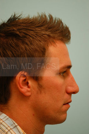 Revision/Corrective Rhinoplasty