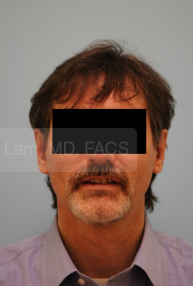 Otoplasty (Cosmetic Ear Reshaping)