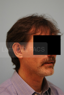 Otoplasty (Cosmetic Ear Reshaping)