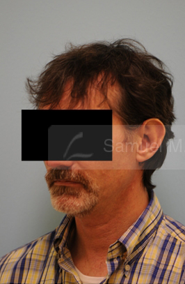 Otoplasty (Cosmetic Ear Reshaping)