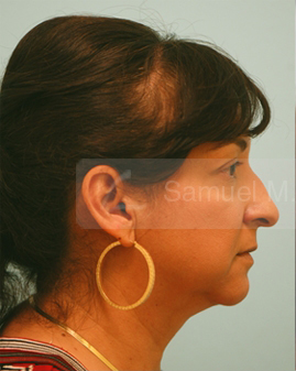 Primary Facial Fat Transfer