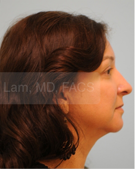 Primary Facial Fat Transfer