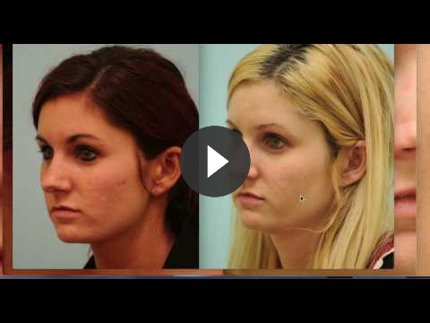 Acne Scarring Correction Videos