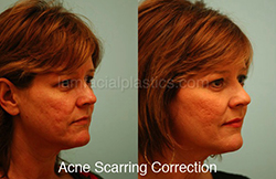 Acne Scarring Before and After