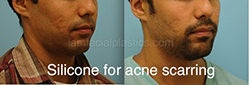 Acne Scarring Before and After