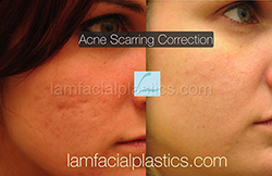 Acne Scarring Before and After