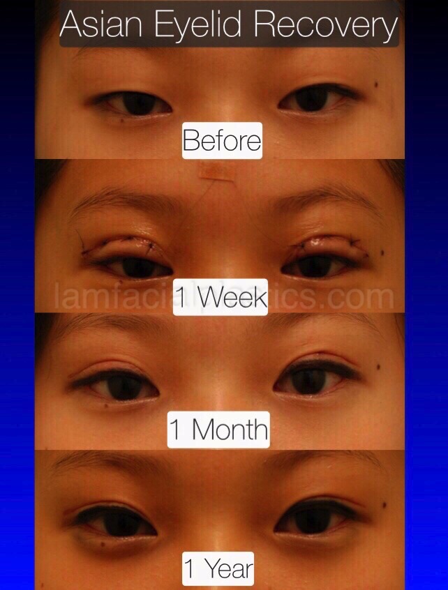 eye surgery round Asian