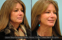 Upper and Lower Eyelid Surgery Before & After