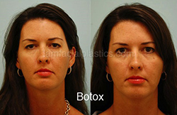 Botox Results Dallas