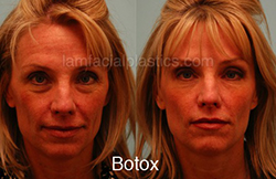 Botox Results Dallas