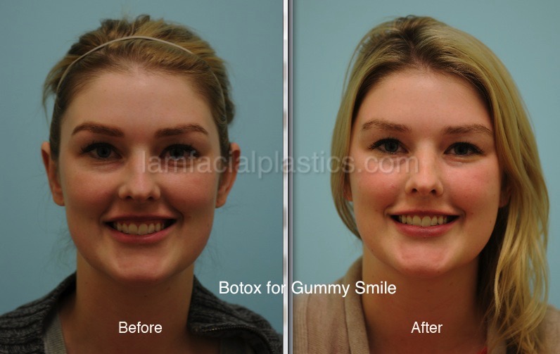 Botox for Wide Nose When Smiling?  