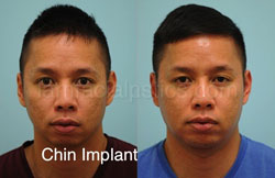 Chin Augmentation Before & After