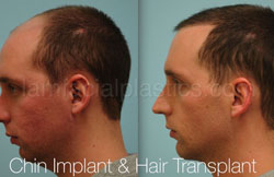 Chin Augmentation Before & After
