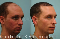Chin Augmentation Before & After