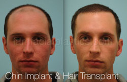 Chin Augmentation Before & After