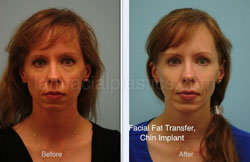 Chin Augmentation Before & After