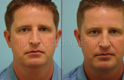 Chin Augmentation Before & After