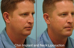 Chin Augmentation Before & After