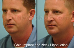 Chin Augmentation Before & After