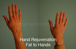 Hand Rejuvenation Before & After