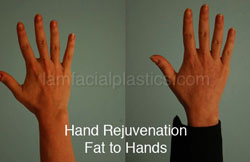 Hand Rejuvenation Before & After
