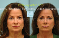 Fat Grafting Before & After