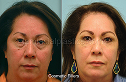 Fillers Before & After