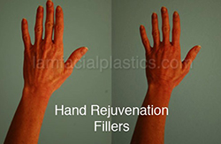 Fillers Before & After