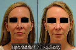 Fillers Before & After