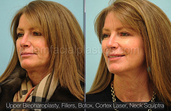 Fillers Before & After