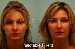 Fillers Before & After