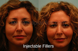 Fillers Before & After