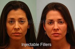 Fillers Before & After