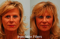 Fillers Before & After