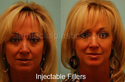 Fillers Before & After