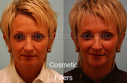 Fillers Before & After