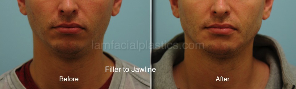 Fillers Before & After