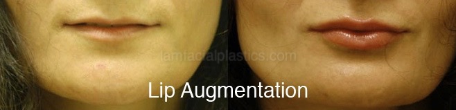 Fillers Before & After