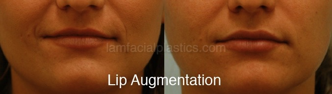 Fillers Before & After