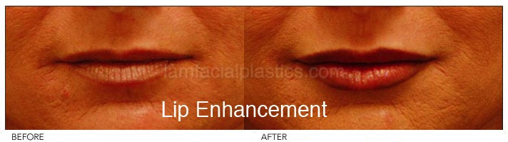 Fillers Before & After