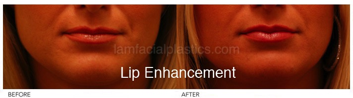 Fillers Before & After