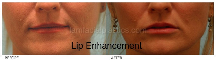 Fillers Before & After