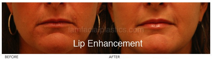 Fillers Before & After