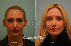 Fillers Before & After