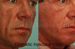 Fillers Before & After