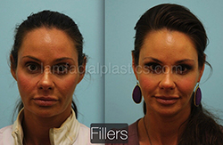 Fillers Before & After